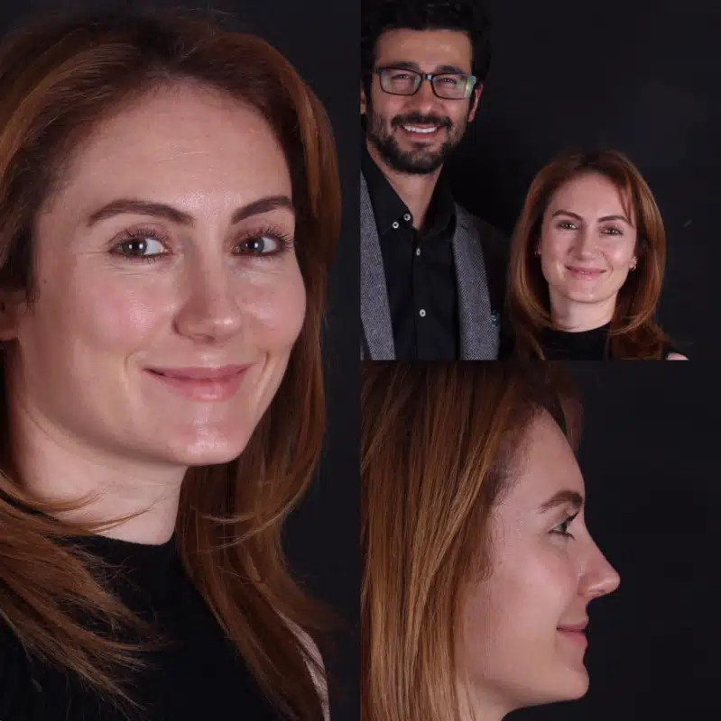 Suleyman Tas reviews – verified rhinoplasty patient review #267