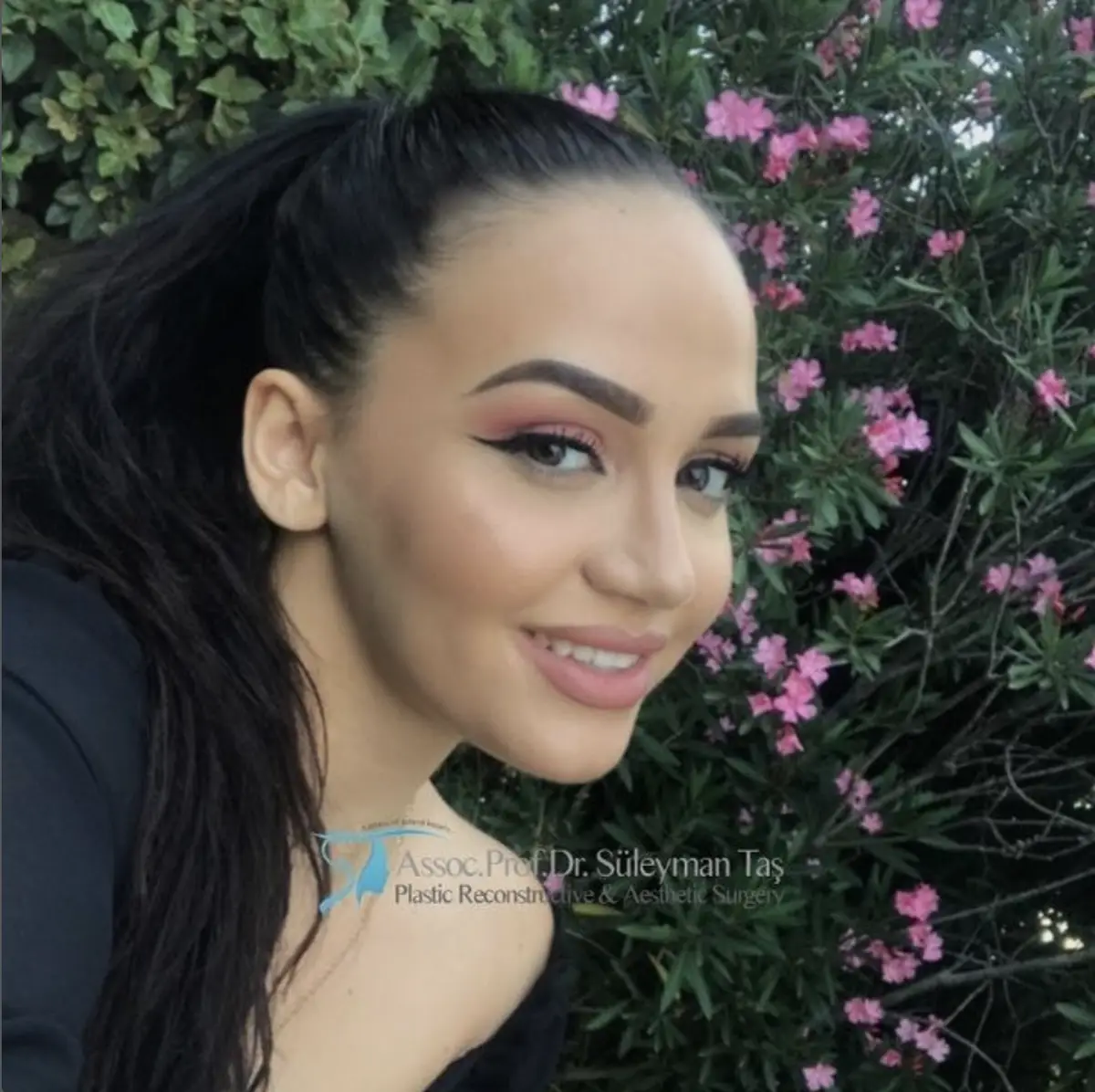 Suleyman Tas reviews – verified rhinoplasty patient review #123