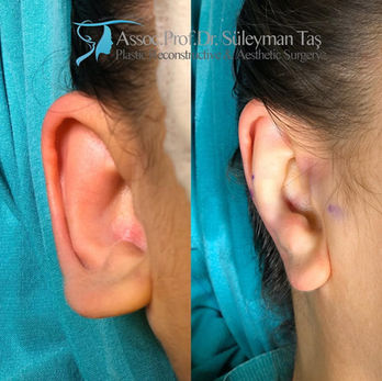 Otoplasty (Ear Pinning) before and after photo of a female patient, side profile view, by Prof. Dr. Süleyman Taş, plastic surgeon in Istanbul