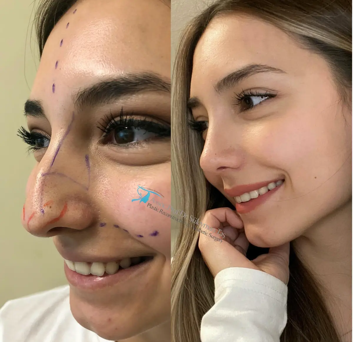 Suleyman Tas reviews – verified rhinoplasty patient review #154 (photo 1)