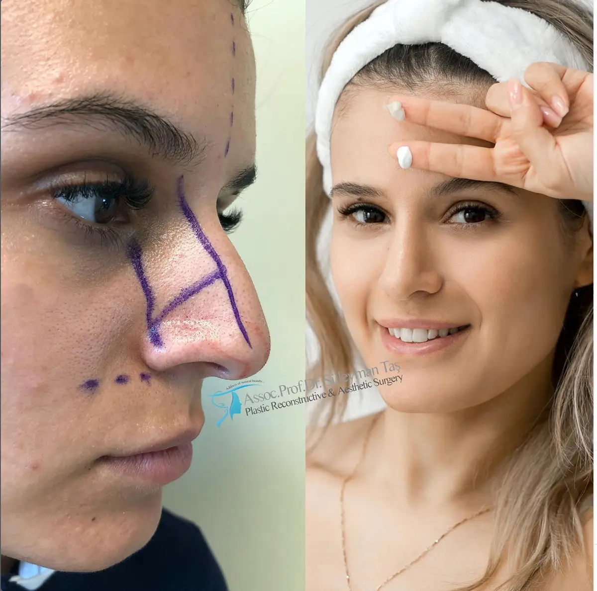 Suleyman Tas reviews – verified rhinoplasty patient review #140 (photo 3)
