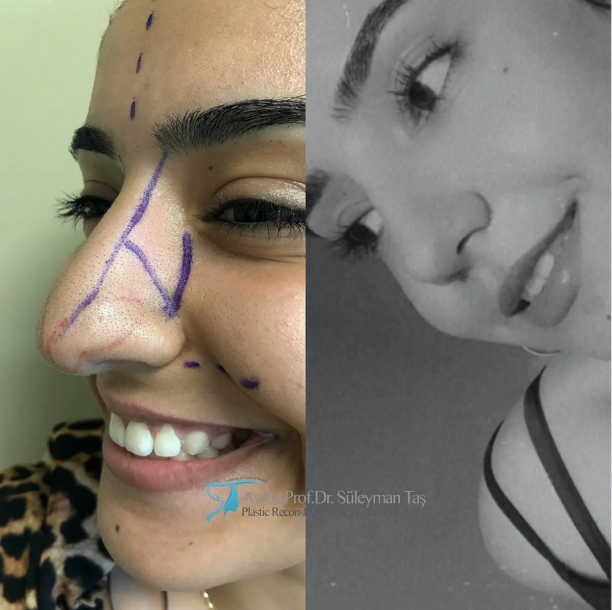 Suleyman Tas reviews – verified rhinoplasty patient review #161 (photo 2)