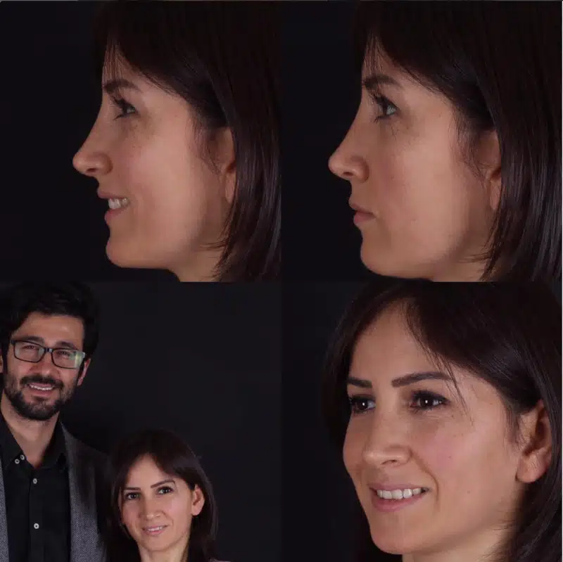 Suleyman Tas reviews – verified rhinoplasty patient review #266