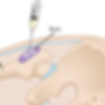 HipBursa-injection.jpg