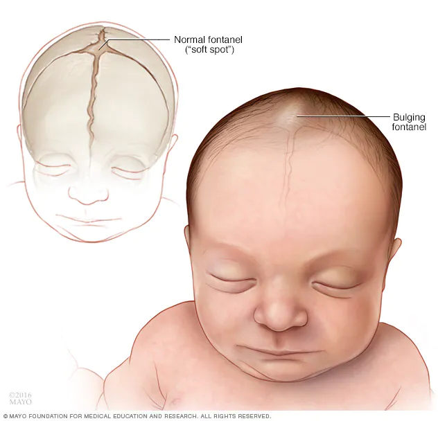 ds00226_im02165_r7_encephfontanellesthu_jpg.jpg.webp