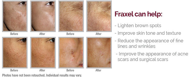 Fraxel before and after