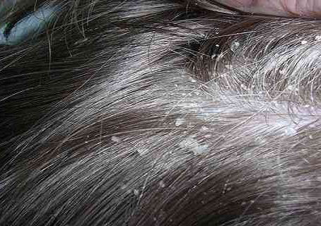 3 Simple Home Remedies Against Dandruff