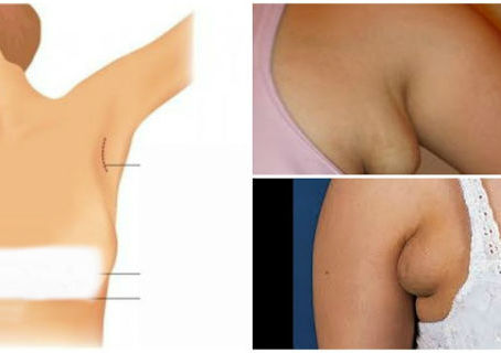 How to Get Rid of Armpits Fat