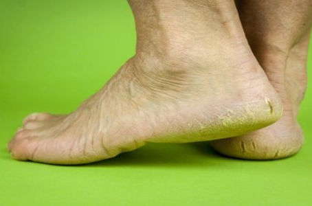 MIRACLE! This Remedy Cures Cracked Heels, Calluses and Varicose Veins in Just 10 Days!