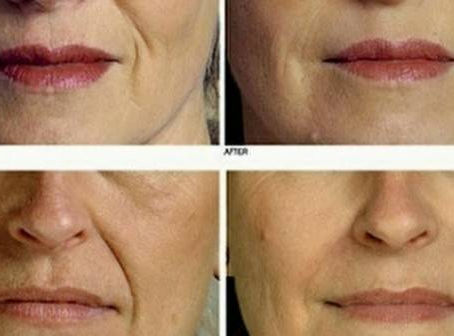 Get Rid Of Wrinkles In 7 Days – Home Made Cream That Will Rejuvenate You