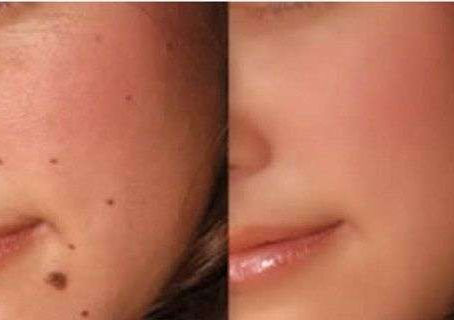 Remove Warts and Skin Tags In 5 Days With One Common Ingredient