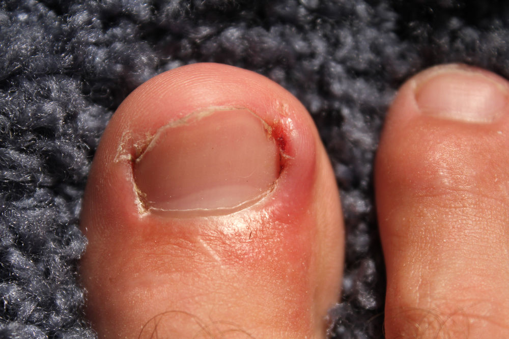 7 Myths of Ingrown Toenails
