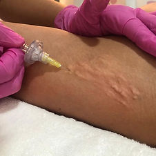 carboxiterapia (5).jpg