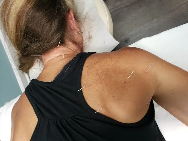 A woman laying on her stomach while receiving dry needling treatment on her back
