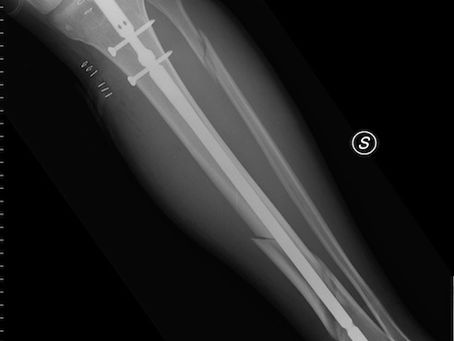 Comment traite t-on une fracture?