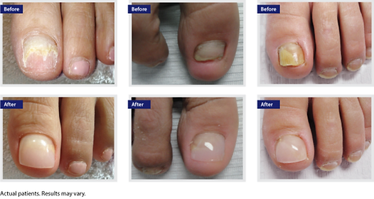 Keryflex toenail restoration