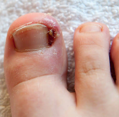 Ingrown Toenail