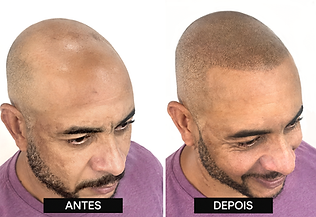 micropigmentação-capilar-cabeça-raspada.png