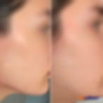 cicatriz_no_rosto_camuflagem_resultado_imediato_micropigmentacao_bh