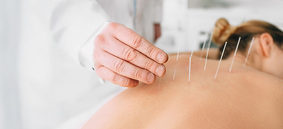 Todo lo que querías saber sobre la acupuntura