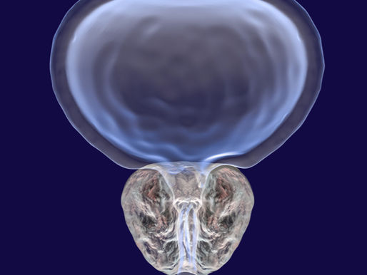 Procedimiento de levantamiento uretral prostático: alternativa para tratar hiperplasia prostática benigna