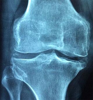 Aprende a identificar signos de osteoporosis