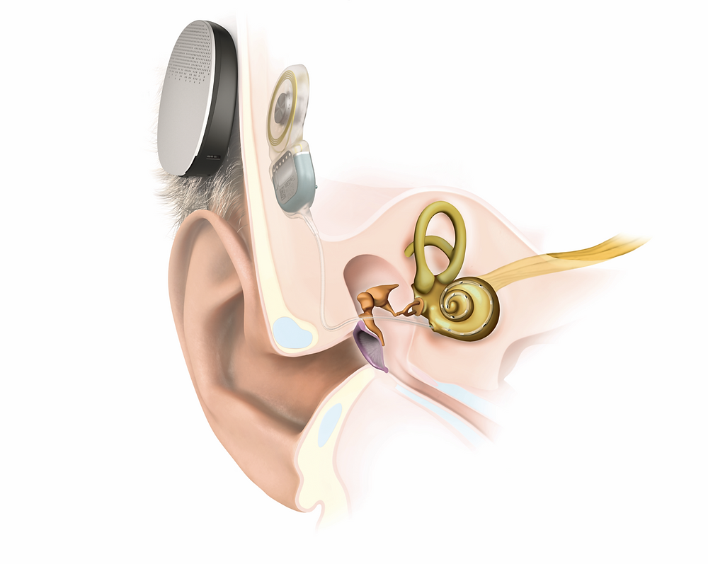 Coclear Importancia de los implantes cocleares: Día Internacional del Implante ...