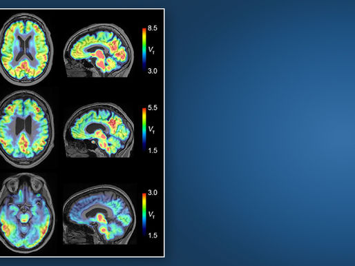 Aprueban análisis de sangre como vía para detectar Alzheimer
