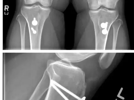 Black-and-white X-ray images of both knees. The top image shows a frontal view of each knee with surgical hardware visible below the kneecaps. The bottom image shows a side view of a knee with two metal screws anchored into the upper tibia beneath the kneecap, indicating prior knee surgery.