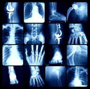 Introduction to Arthritis and X-Ray Diagnostics