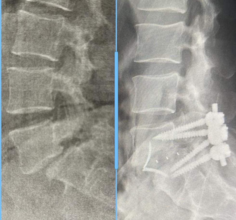 Radiografia da coluna lobmar em perfisl, com duas imagens, sendo uma radiografia com espondilolistese de nivel de L5-S1 e a outra com rx com tratamento e fixação com um cage anterior e com 4 parafusos posteriores de fixação da espondilolistese