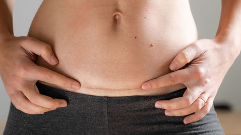 woman with a cesarean section scar