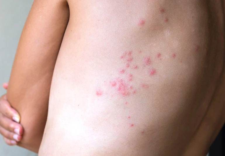 royse city bedbug control