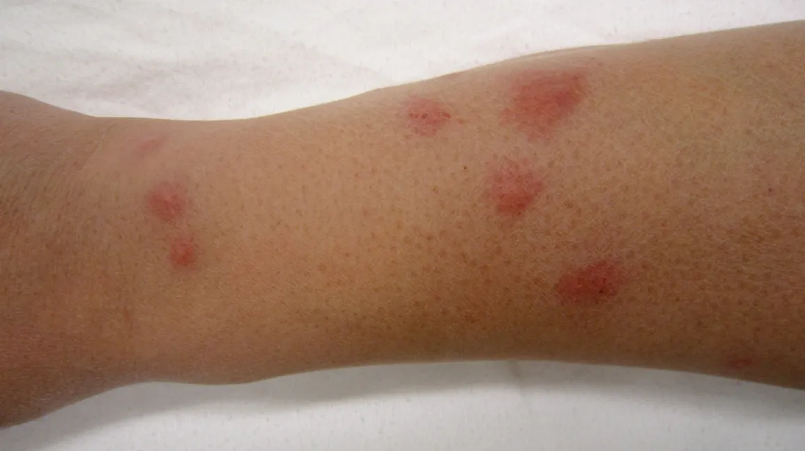 royse city bedbug control