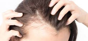 PRP for Hair Loss: Is it Worth the Hype?