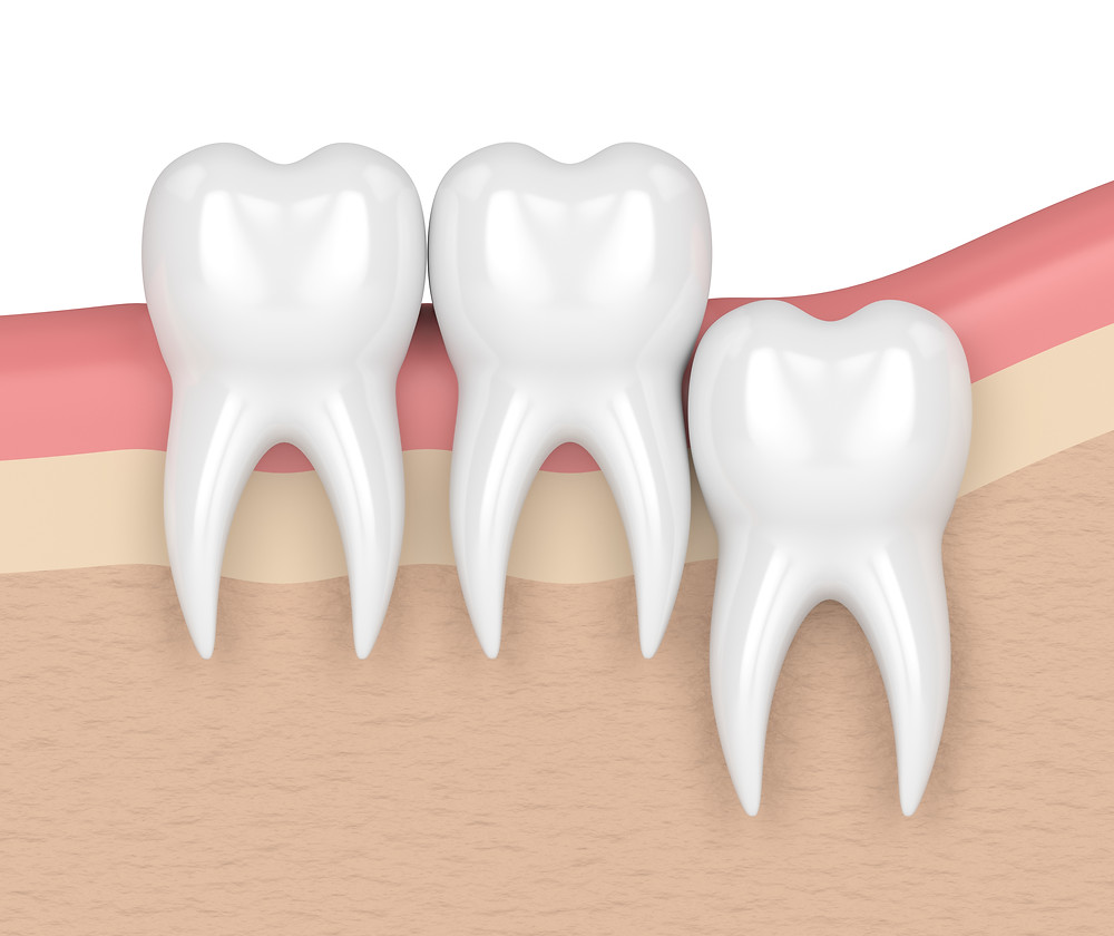 Bellevue Park Dental in Bellevue, WA 98008 Family Cosmetic Implants Invisalign Braces Dentist - Crowns, Wisdom Teeth Extraction, IV Sedation, Kor Teeth Whitening, Tooth Bonding, Porcelain Veneers, Bridges, Fillings, Dentures, Children's Dentistry, Tooth Extractions, Exams, Cleanings, Root Canal Therapy, Dental check Up, Botox & Dermal Fillers, Inlay & Onlays