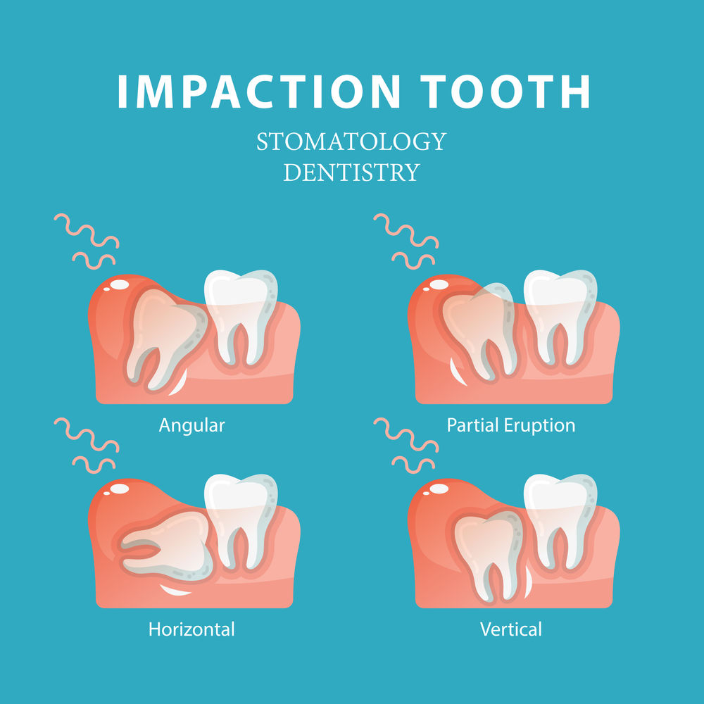 What Problems Can Impacted Wisdom Teeth Cause Dallas Emergency Dentist
