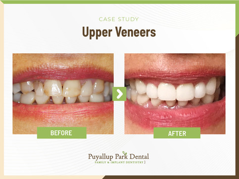 Puyallup Park Dental in Puyallup, WA 98374 Family Cosmetic Veneers Implants Invisalign Emergency Dentist - Crowns, Wisdom Teeth Extraction, IV Sedation, Kor Teeth Whitening, Tooth Bonding, Porcelain Veneers, Bridges, Fillings, Dentures, Children's Dentistry, Tooth Extractions, Exams, Cleanings, Root Canal Therapy, Dental check Up, Inlay & Onlays