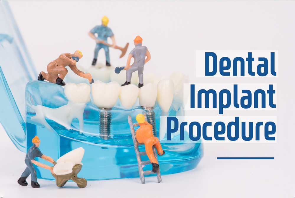 Step By Step Two Stage Dental Implant Procedure in Paul Sioda