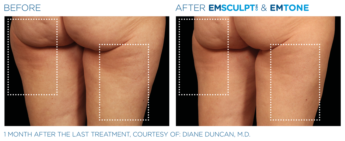 Emsculpt_Neo-Emtone_PIC_Ba-card-female-back-thigh-002_ENUS100.png