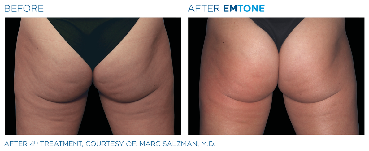 Emtone_PIC_Ba-card-female-buttock-001_EN100.png