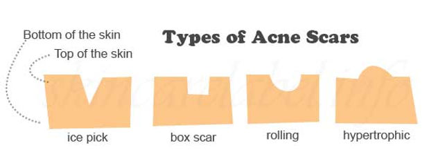 Acne Scars treatment