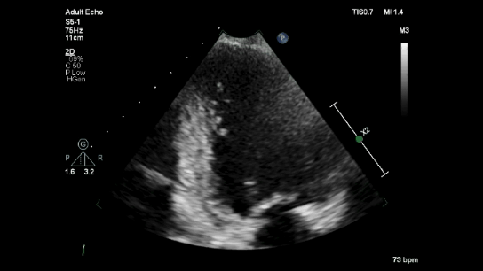 A2C LVEF 40%