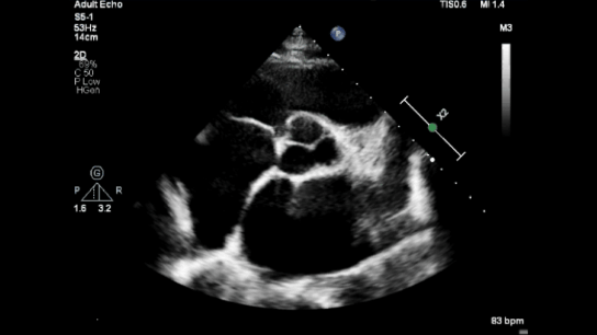 rheumatic mitral stenosis parasternal short axis at aortic valve