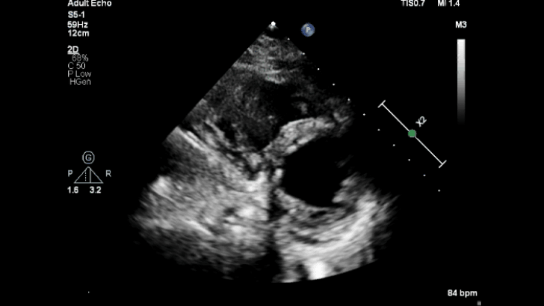 rheumatic mitral stenosis parasternal short axis