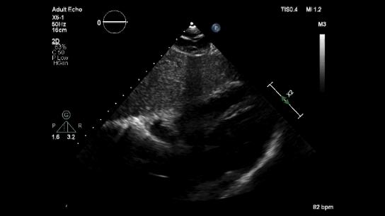 subxiphoid.gif