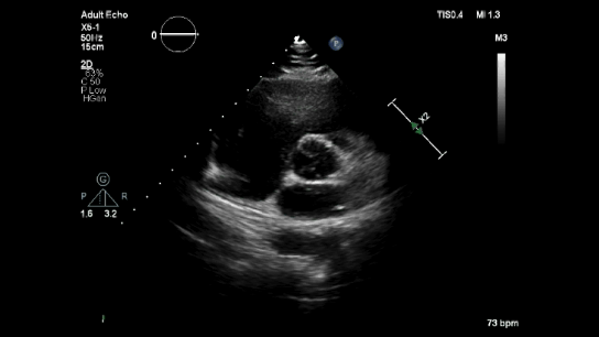 PSAX aortic valve