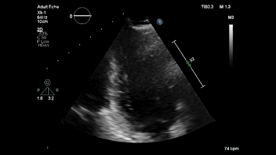 A2C LVEF 70%