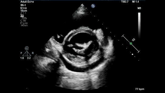 rheumatic mitral stenosis parasternal short axis at mitral valve