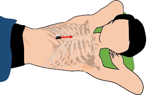 subxiphoid view